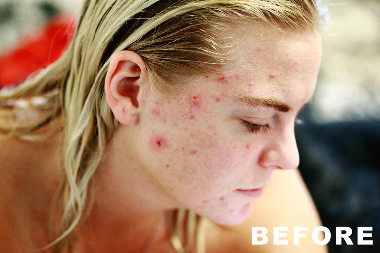 Girl acne before being edited